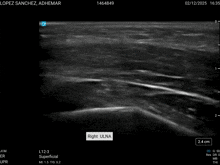 an ultrasound of the right ulna of a person 's knee
