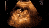 an ultrasound of a baby in a woman 's womb .
