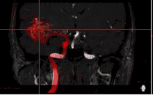 Eximius Angio GIF - Eximius Angio Brain GIFs