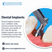 Dental Implant Centre Full Dental Implants GIF - Dental Implant Centre Full Dental Implants Tooth Implant GIFs