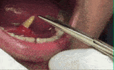 Tonsil Stone Gross GIF - Tonsil Stone Gross Mouth GIFs