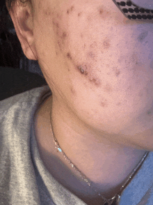 a close up of a person 's face with acne