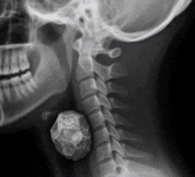a black and white x-ray of a person 's head and neck with a rock in it .