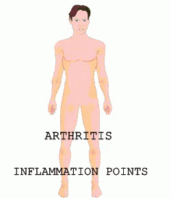 Arthritis Joint Inflammation GIF - Arthritis Inflammation Joint Inflamation GIFs