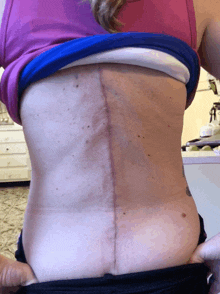 Scoliosis Bad Ass Scar GIF - Scoliosis Bad Ass Scar Get Bent GIFs