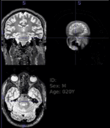 Mri Brain Mri GIF - Mri Brain Mri Human Mind GIFs
