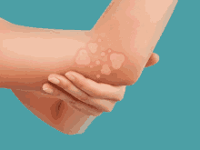 eczema dry skin skin rash