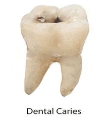 Dental Caries GIF