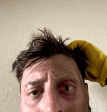a man with a black eye is being held by a yellow glove