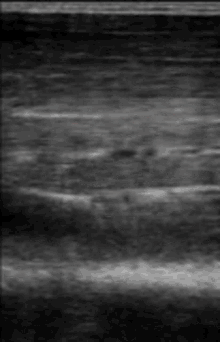 ultrasound muscle biceps