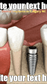 Dental Implants In Calgaryne Ne Calgary Dental Implants GIF
