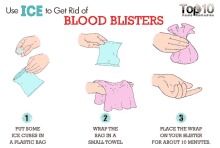 Blister GIF - Blister Blood Blister Get Rid Of GIFs