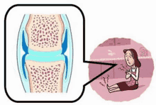 Arthritis Painful Joints GIF - Arthritis Pain Inflammation GIFs