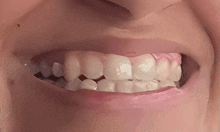 a close up of a person 's teeth with a small hole in the middle