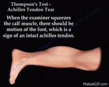 Thompson Test Achilles Tendon GIF - Thompson Test Achilles Tendon GIFs
