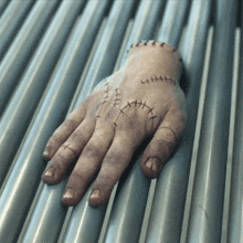 a hand with several stitches on it is laying on a metal surface