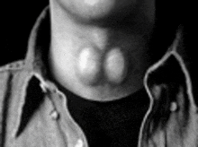 a black and white photo of a man 's neck with a large bump on it .