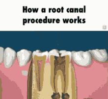 Endodoncia Dental GIF - Endodoncia Dental Root Canal GIFs