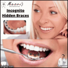 Incognito Hidden Braces Smile GIF - Incognito Hidden Braces Smile Teeth GIFs