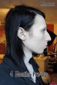 Nose Job Difference GIF