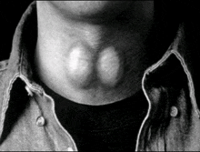 a black and white photo of a man 's neck with two lumps on it