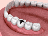 Dentist Teeth GIF - Dentist Teeth Filling GIFs