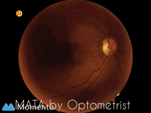 fundus mata fundus mata by optometrist mata by optometrist optometrist