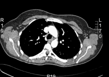 Abdominal Ct Scan GIF