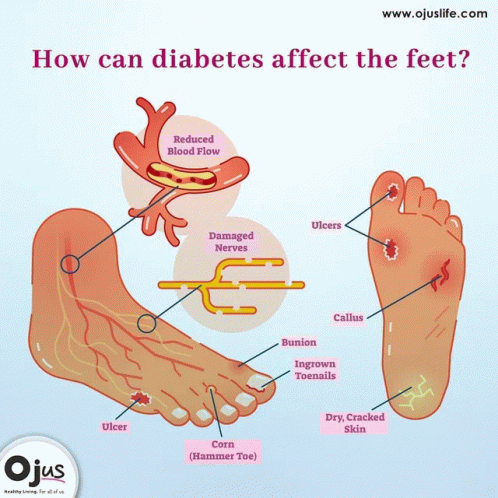 Diabetes Diabetic GIF - Diabetes Diabetic Diabeticneuropathy - Discover ...