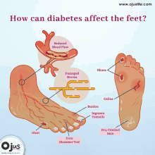 Diabetes Diabetic GIF - Diabetes Diabetic Diabeticneuropathy GIFs