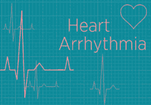 Arrhythmia Cardiac GIF - Arrhythmia Cardiac Beat GIFs