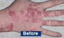 Eczema GIF - Eczema Before And After Dry Skin GIFs