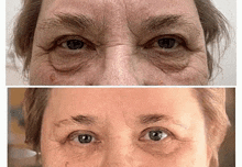 a before and after photo of a woman 's eyes with wrinkles