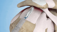 Regeneten Patch GIF - Regeneten Patch Implant GIFs
