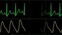 Ekg Heart Rate GIF - Ekg Heart Rate GIFs