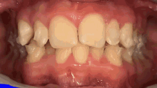 Teeth GIF - Teeth GIFs