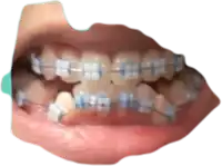 a close up of a person 's mouth with blue and white braces