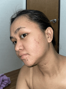 a woman with acne on her face is looking at herself in the mirror