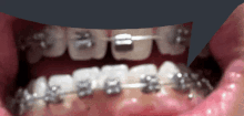 Teeth Bubble GIF - Teeth Bubble React GIFs
