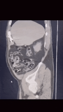 a ct scan of a person 's abdomen shows a large amount of tissue