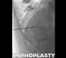 Kyphoplasty Irad GIF - Kyphoplasty Kypho Irad GIFs