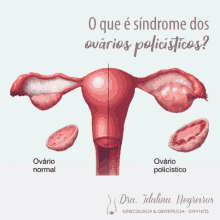 Ob Gyne Obstetrics And Gynaecology GIF - Ob Gyne Obstetrics And Gynaecology Polycystic Ovary Syndrome GIFs