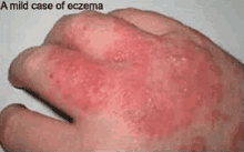 Eczema GIF