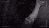 a person with a bandage on their arm is being recorded in a black and white video