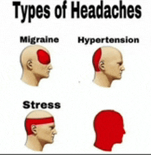 types of headaches include migraine , hypertension , stress , and headache .