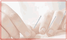 acupuncture in