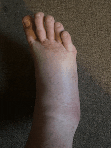 a close up of a person 's foot showing the toes