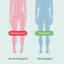 a diagram showing a person with misalignment and a person with arch support