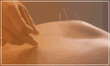 Acupuncture Treatment In Toronto Acupuncture Treatment Clinic GIF - Acupuncture Treatment In Toronto Acupuncture Treatment Clinic Best Acupuncture Treatment GIFs