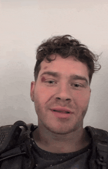 a man with a bruise on his forehead is smiling for the camera